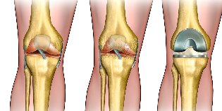 o que é a osteoartrite