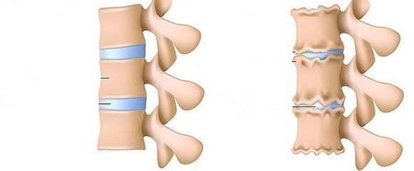 uma coluna saudável e osteocondrose