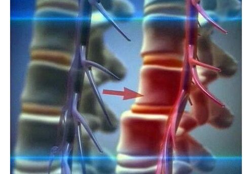 Compressão das terminações nervosas na osteocondrose lombar