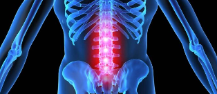 A deformação intervertebral disco