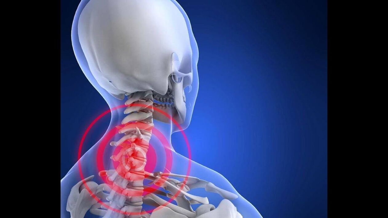 Osteocondrose da coluna cervical
