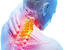 Os principais sinais e sintomas da osteocondrose cervical