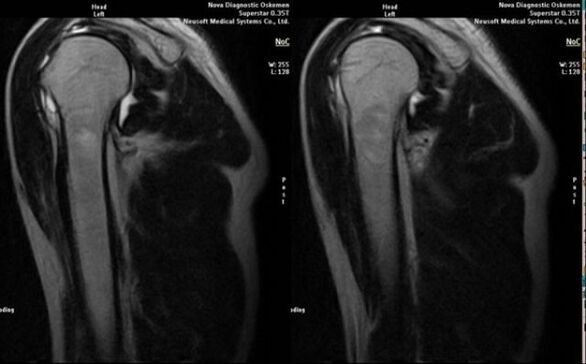 radiografia para diagnosticar artrose do ombro