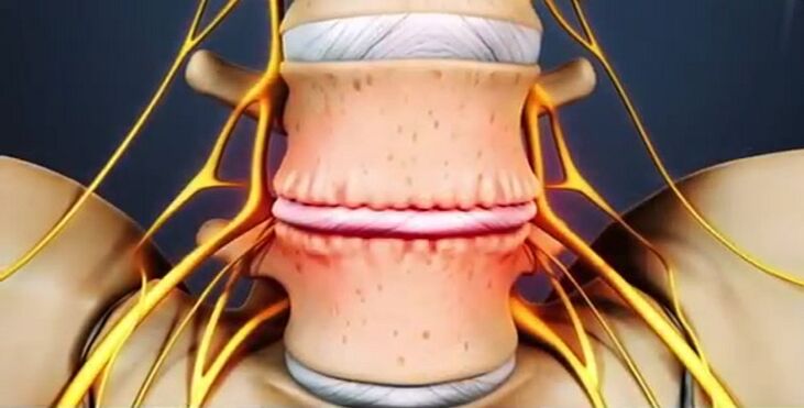 lesões espinhais devido à osteocondrose